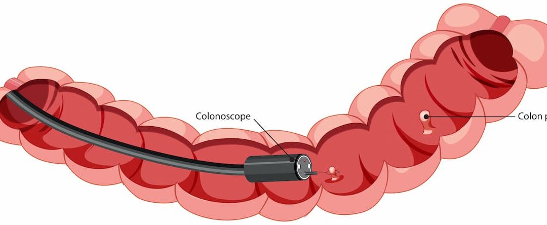 Colonoscopia: Preguntas y Respuestas