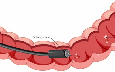 Colonoscopia: Preguntas y Respuestas